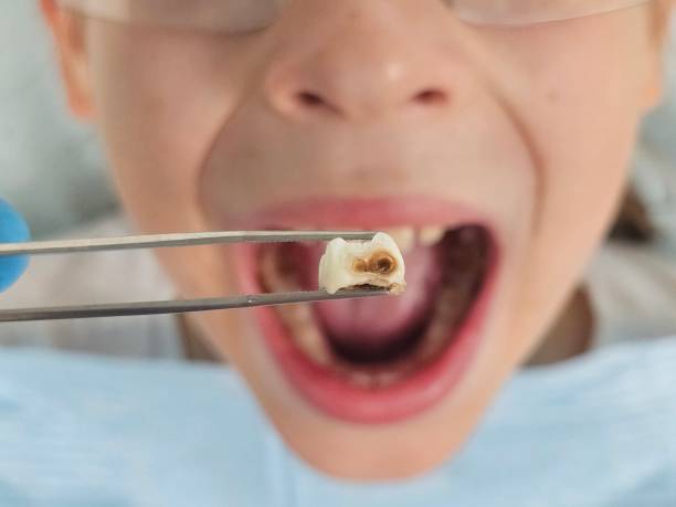 Best Emergency Treatment for Dental Infections or Abscesses in Waupun, WI